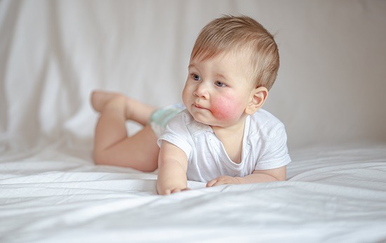 Dermatita atopică la copii – cauze şi măsuri de tratament