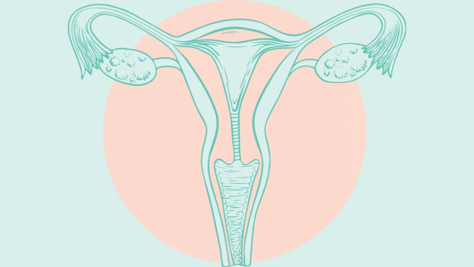 Cancer ovarian: simptome, tratament