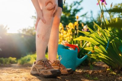 Cum sa preveniti si sa tratati venele sparte pe picioare – sfaturi si remedii eficiente